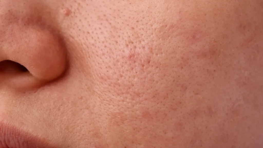 Close-up of enlarged pores on a woman’s face.