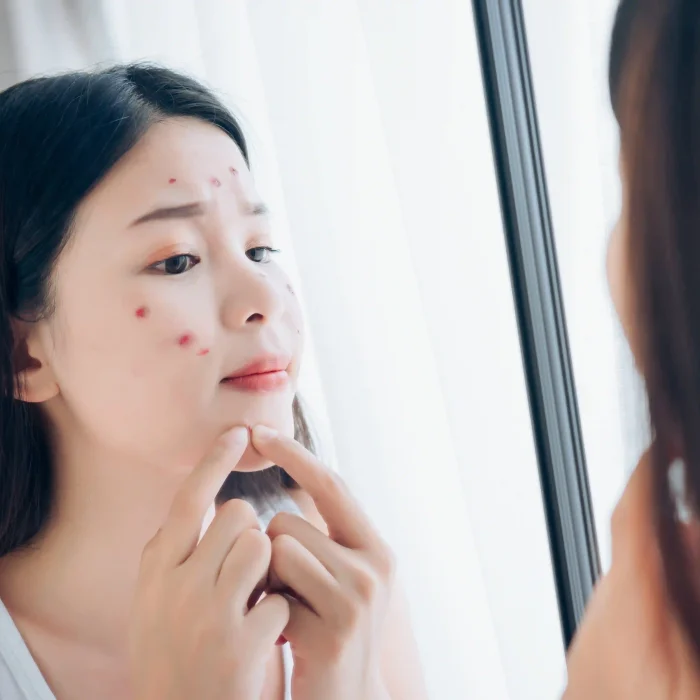 A teenager squeezing a pimple on her chin, showing acne and scars treatment concerns - Illumia Therapeutics