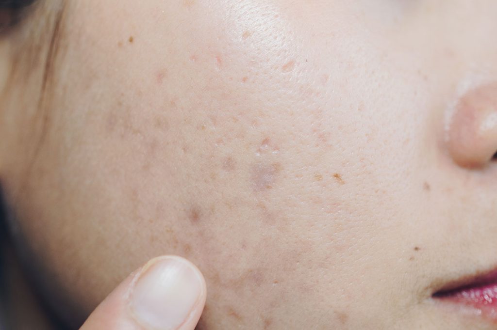 Close-up of acne scarring on a woman’s face - Illumia Therapeutics
