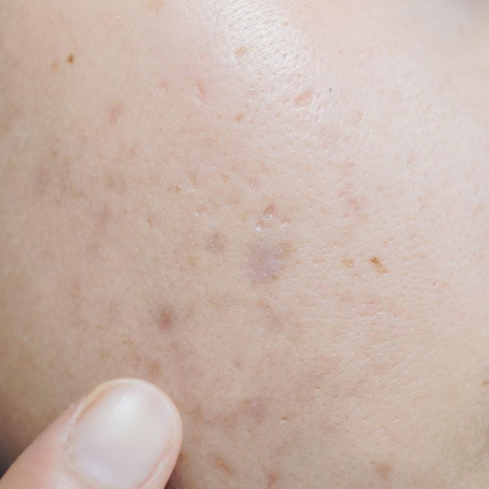 Close-up of acne scarring on a woman’s face - Illumia Therapeutics